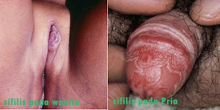 Penyebab Penyakit Sipilis Kumpulan Tips