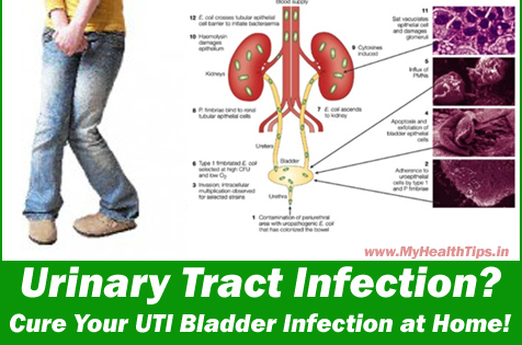 Home cure for bladder infection