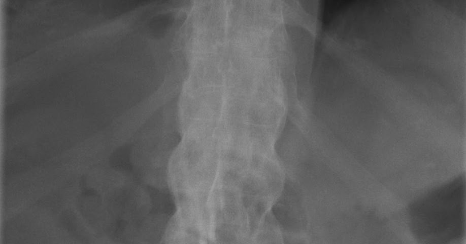 the xray doctor: xrayoftheweek 42: a classic spine x-ray