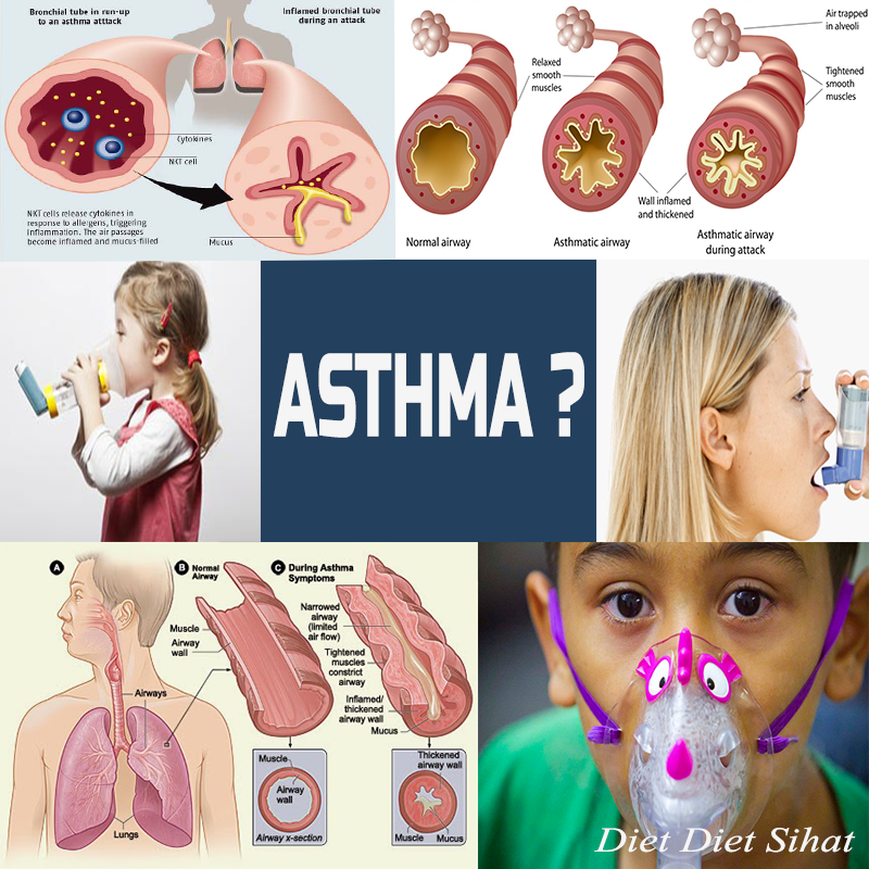 rawat asma sekarang