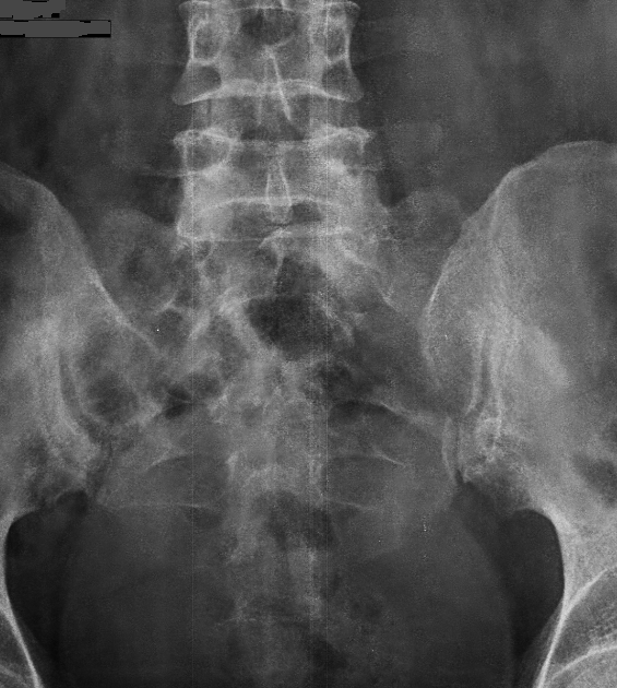 Stress Fracture Sacrum Case Discussion Radiology Imaging