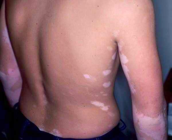 White Spots: Symptoms, Causes and Treatments