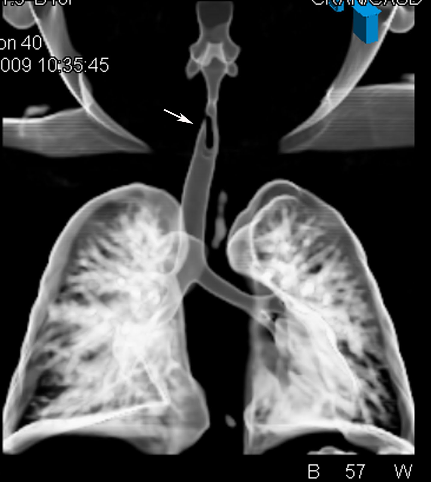 Radiodiagnosis Imaging is AmazingInteresting cases Tracheal Foreign