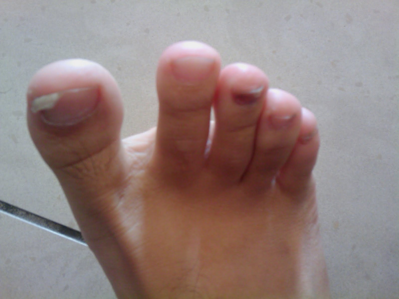 Journey of A Medie On the Unhealthy Nails