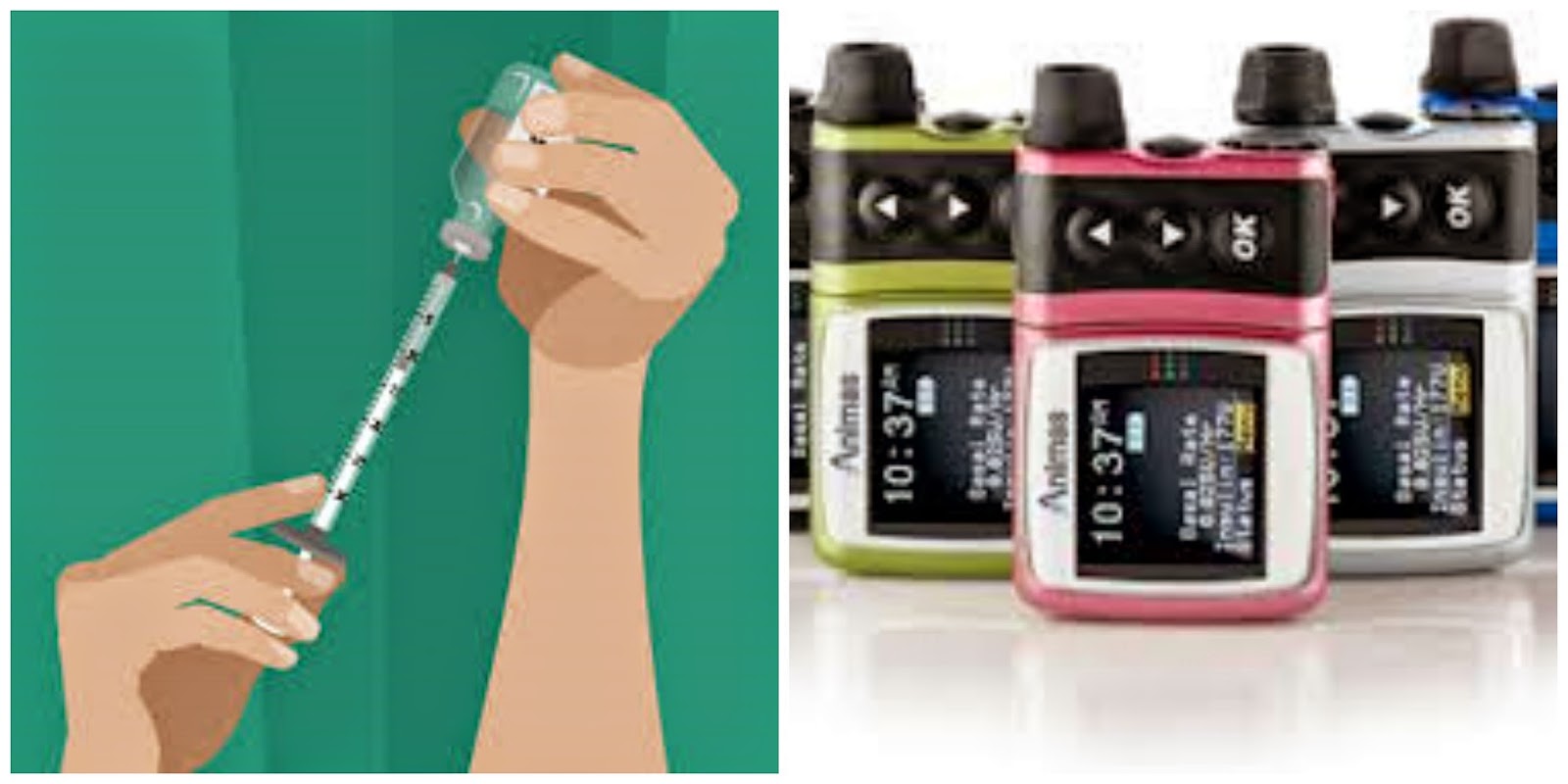 Darling Diabetic Multiple Daily Injections vs. Insulin Pump Therapy