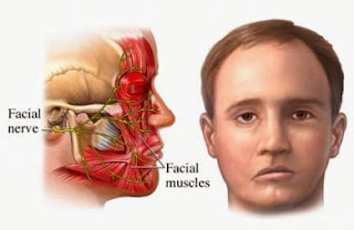 What Is Bell's Palsy