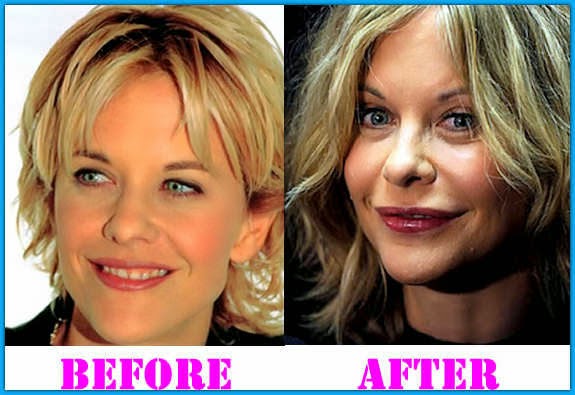 Meg Ryan Plastic Surgery Facelift Before and After Botox Injections(04)