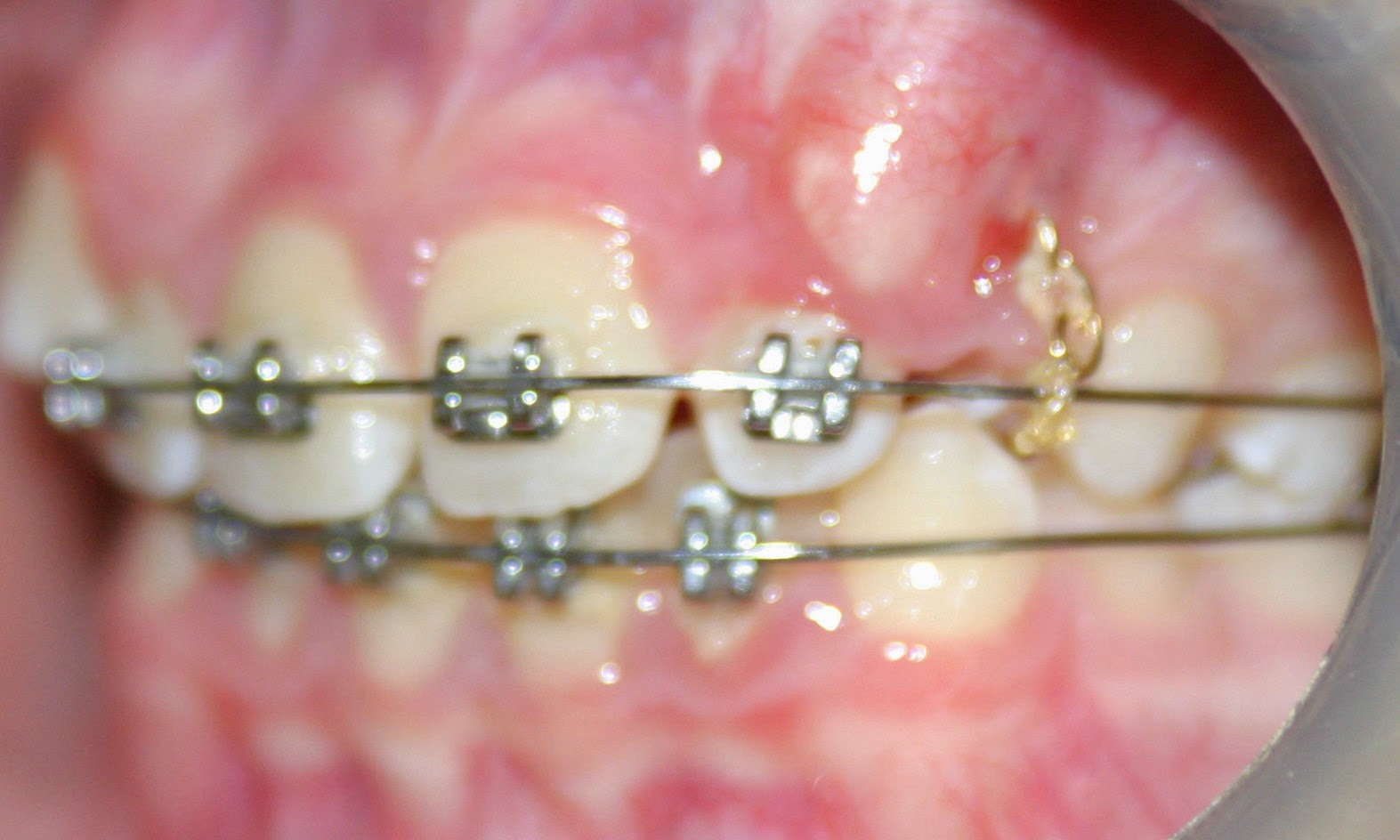 Chain To Pull Down Canine Tooth at Edith Cannon blog