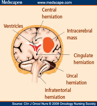 brain herniation