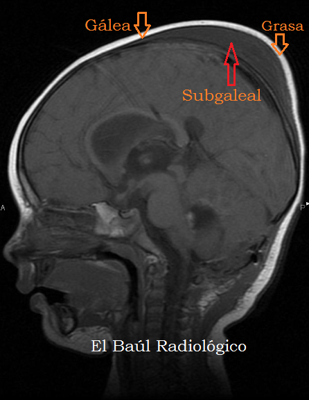 subgaleal hemorrhage