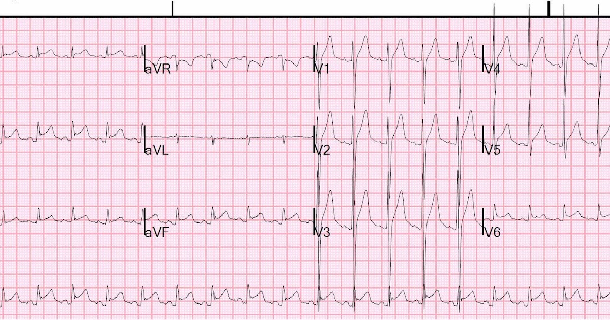 Dr. Smith's ECG Blog Chest pain, tachycardia, diffuse ST elevation