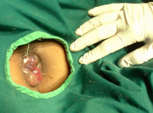obat wasir yang sudah keluar, obat wasir, obat ambeien