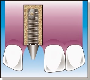 www.dentistinchennai.com/implant-procedures.php