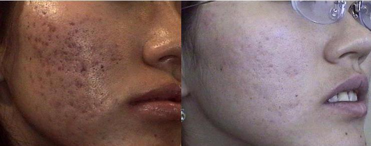 Las manchas de pigmento de los labios grandes sexuales