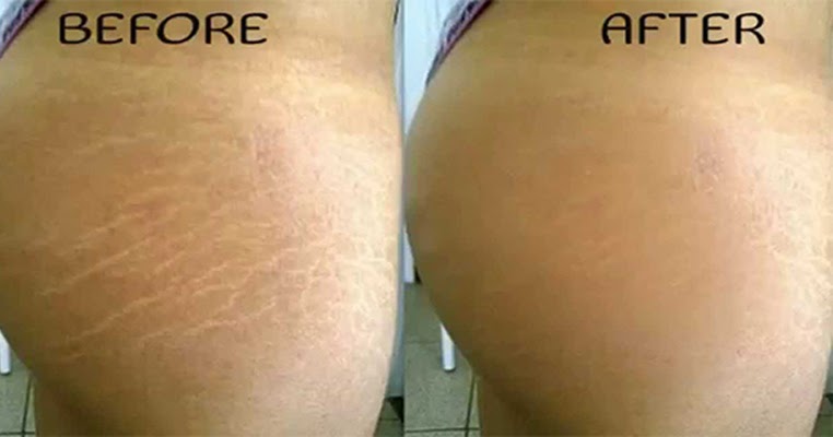 How To Remove Stretch Marks Naturally Home Remedies How To Remove Stretch Marks Naturally Home Remedies