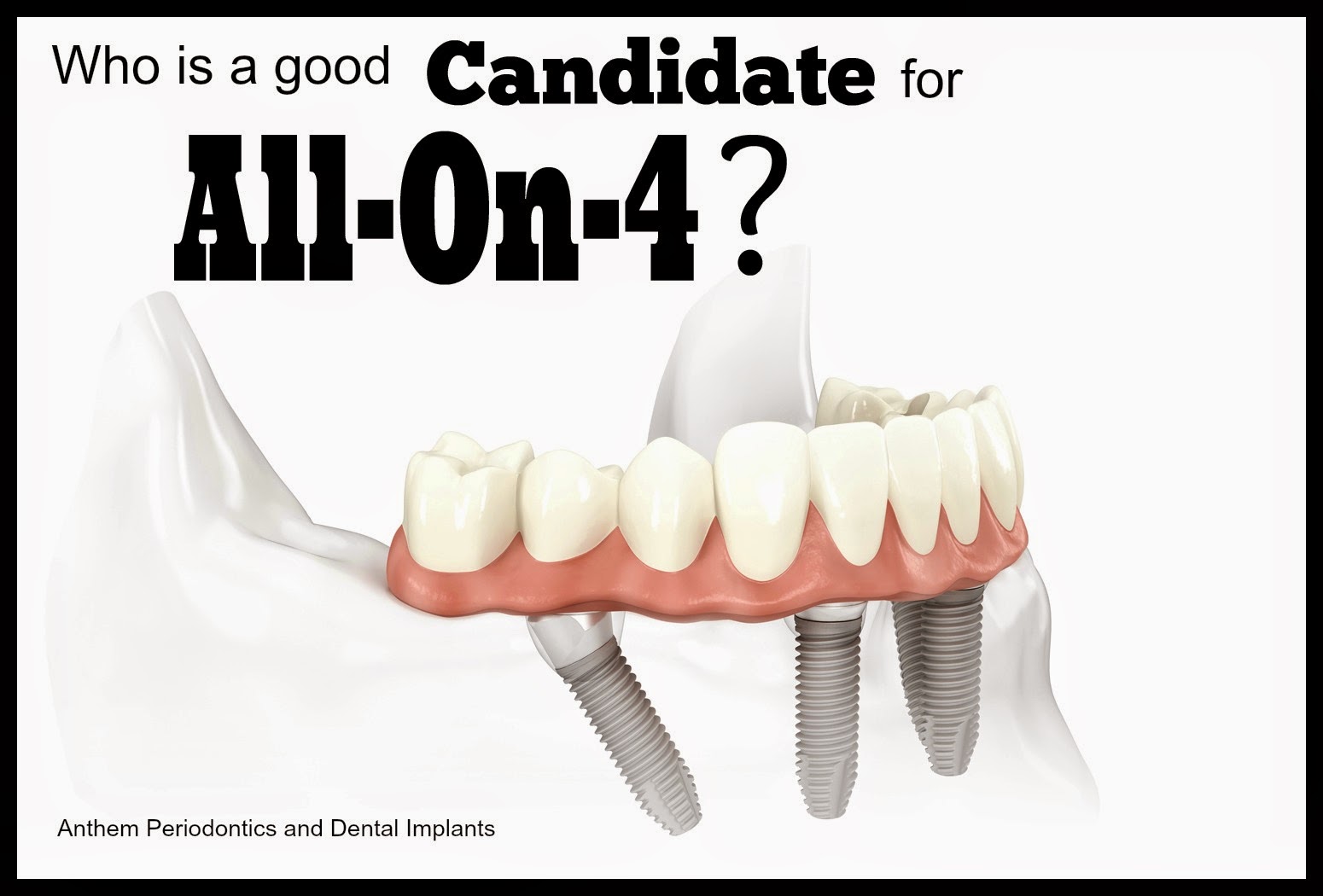 Dental Implants Las Vegas, Periodontist Las Vegas Are You A Good