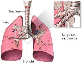 Lung Cancer Lung cancer definition, Lung cancer prognosis, symptoms lung cancer, cancer symptoms, symptoms of cancer, small cell cancer, lung cancer smoking, lung cancer treatment, lung cancer survival, lung cancer pain
