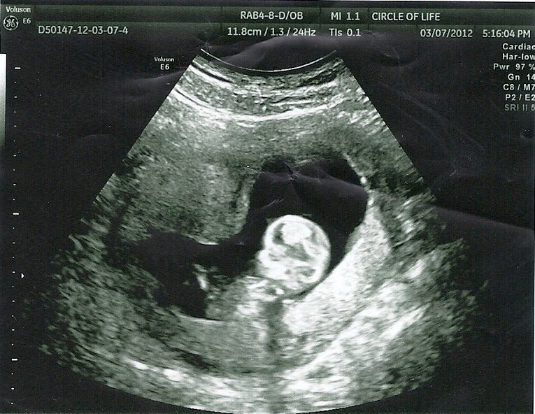 It's A Cardall Thing... My 3 Month Ultrasound