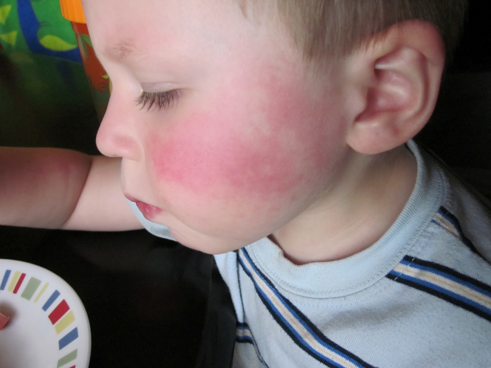 Squirrely Days and Chicken Nights All Rashy