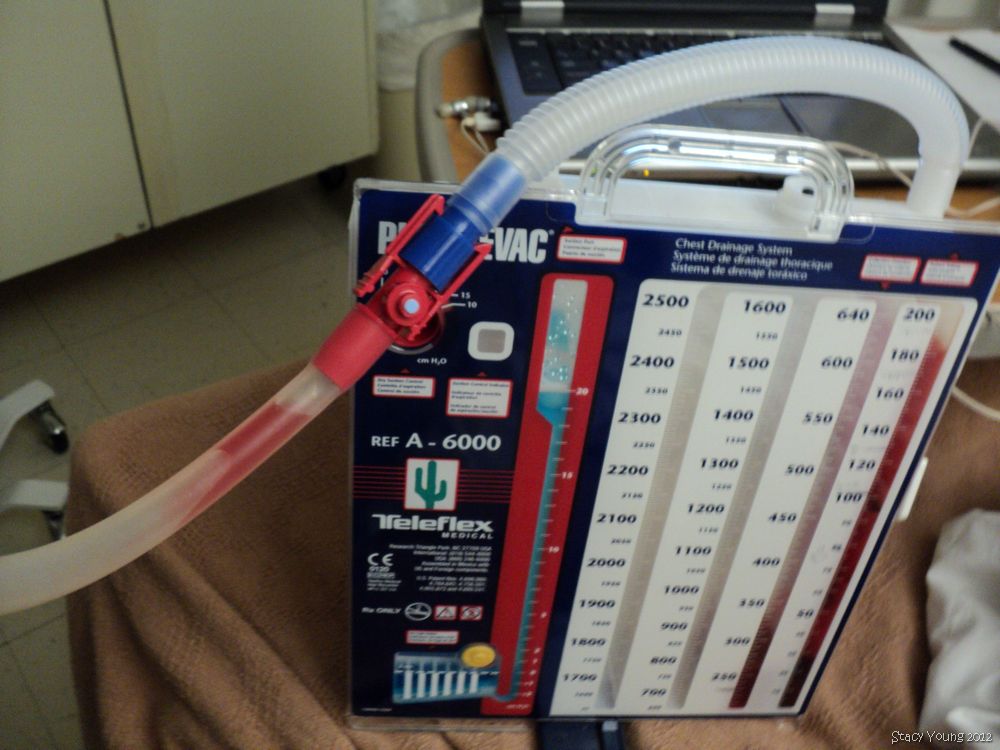 My Eclectic Thoughts My experiences with the latest Pneumothorax, VATS