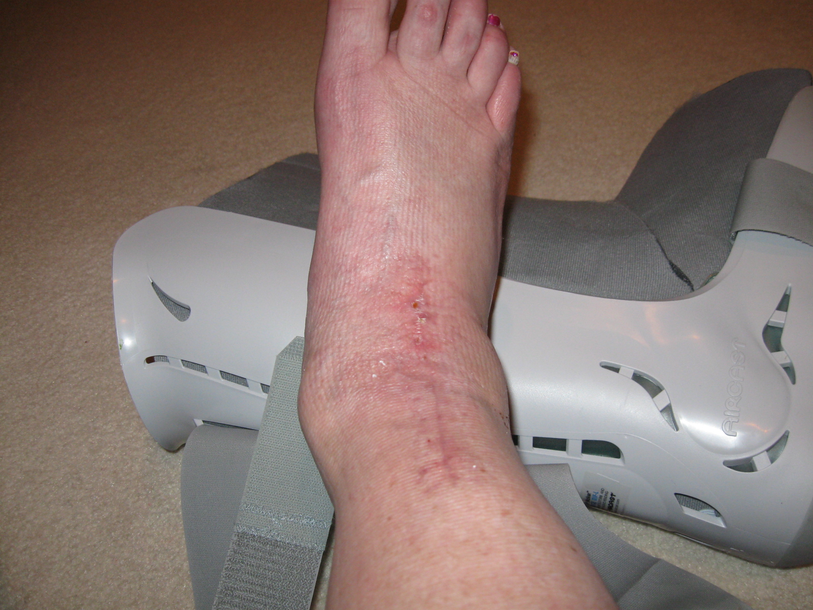 My Ankle Replacement 8 Weeks PostOp....Really?