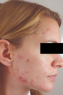 L'acné kystique