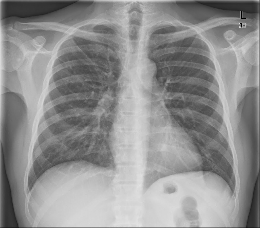 รายการ 100+ ภาพ เอ็กซเรย์ทรวงอก อัปเดต