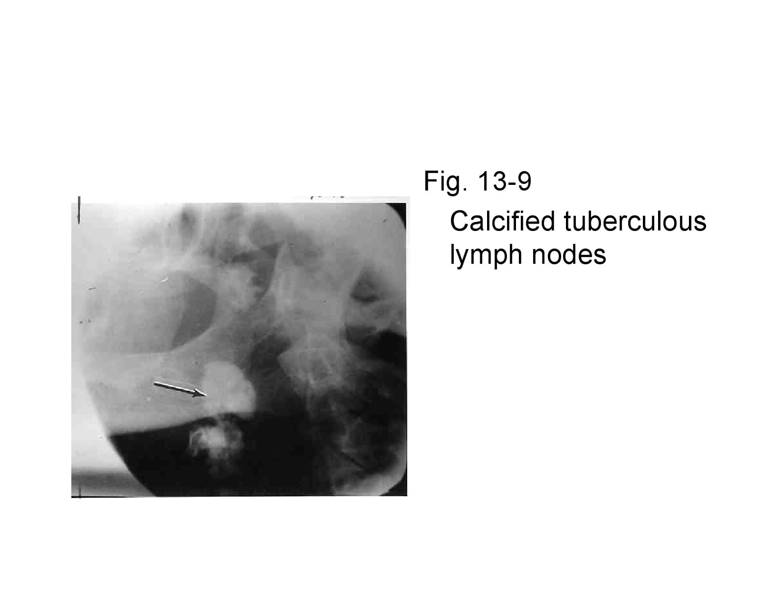 Osteomyelitiswith Radiological features Dentistry and Medicine