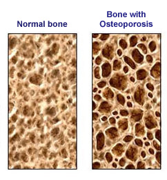 http://healthwill.blogspot.com.au/2011/07/healthy-bone-osteoporosis-free.html