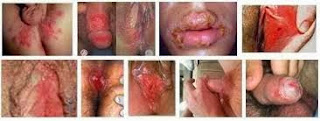 obat sipilis obat sipilis