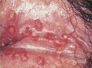 Gejala Penyakit Herpes Pada Kelamin