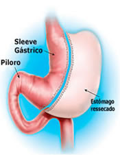 Técnica escolhida Sleeve Gástrico