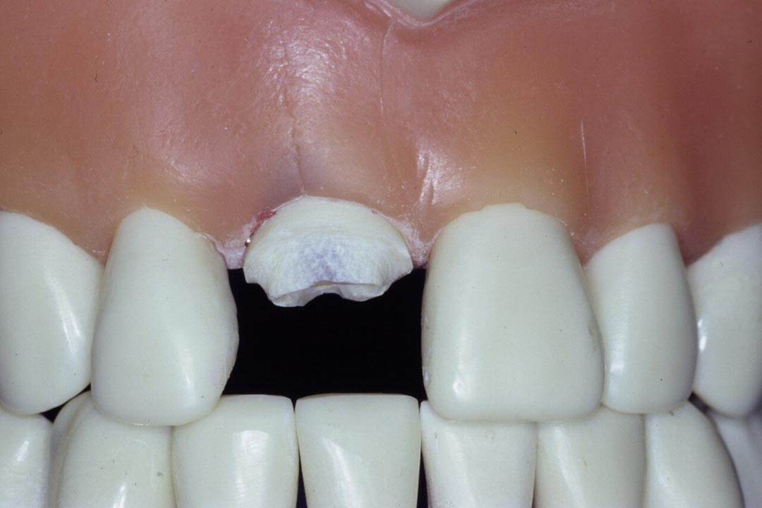 Dentistry Custom Cast Dowel Core