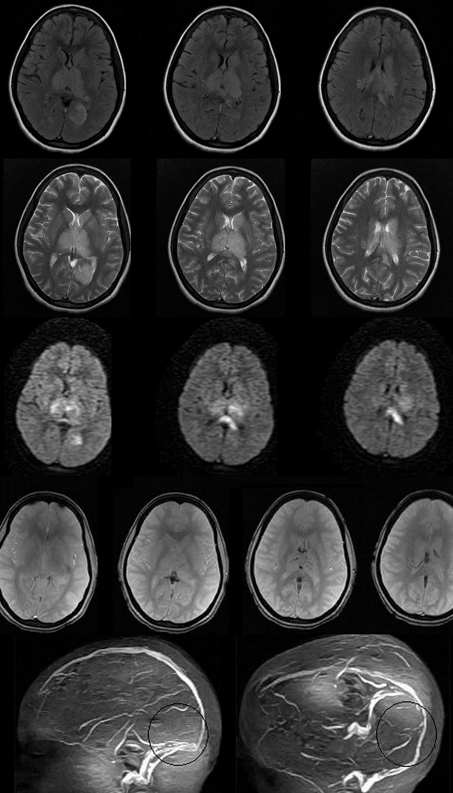 Arachnoiditis Mri
