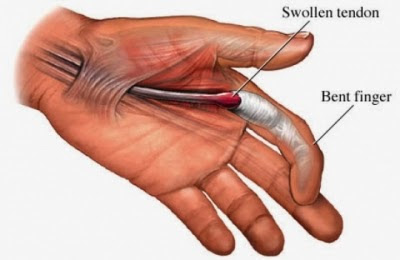 Obat Trigger Finger Herbal | Blog Seputar Informasi Kesehatan