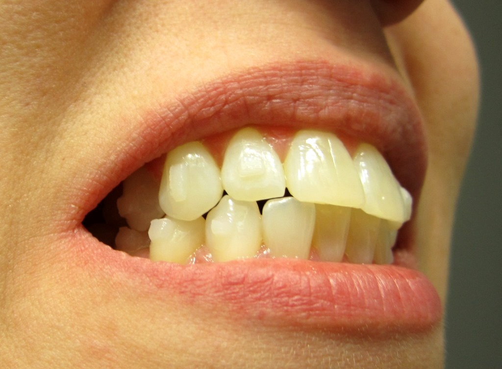 invisalign attachments