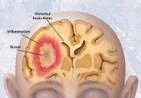 gejala tumor otak