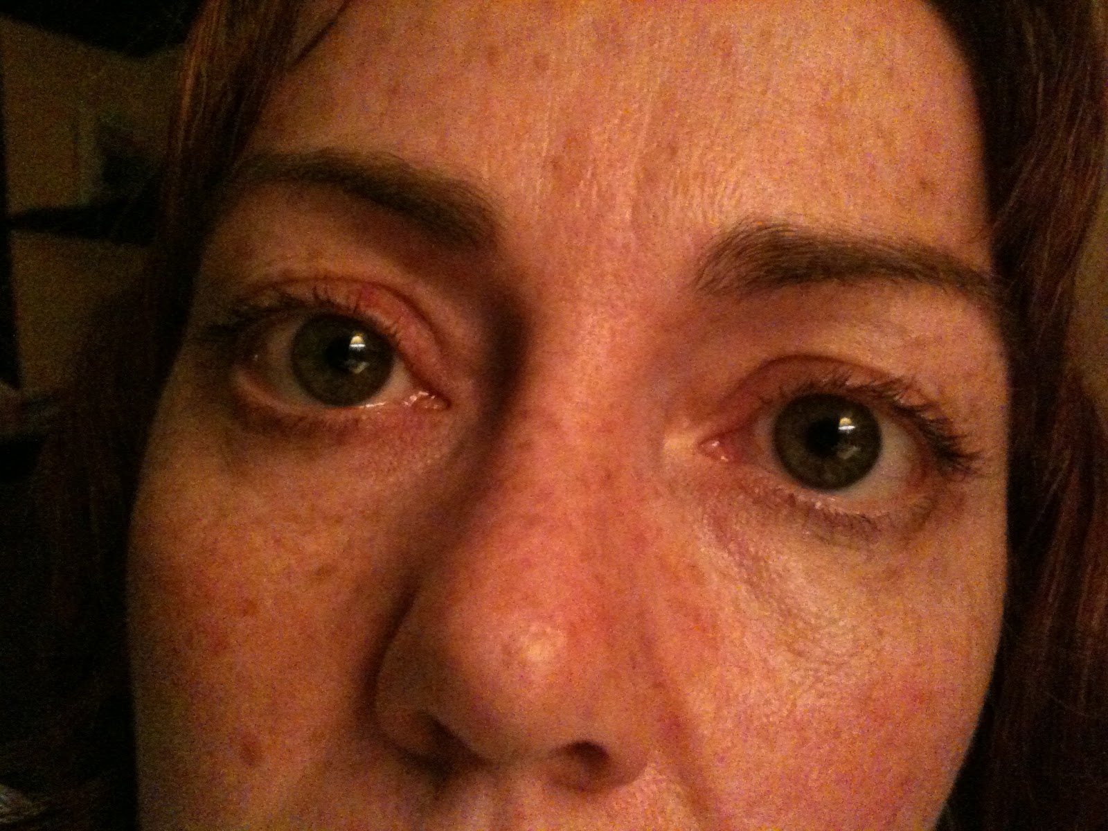 Lyme Disease Scotland get info, get treated, get better. Herxing