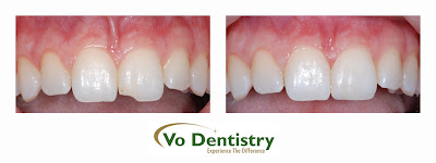 Tooth color filling, economic veneer, cosmetic dentist, Lawrenceville Ga