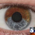 Procedimento com laser transforma olhos castanhos em azuis!