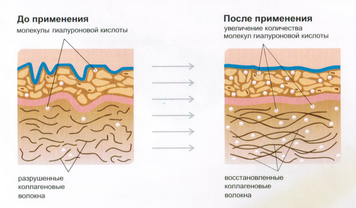 Синтез гиалуроновой кислоты в коже Синтез гиалуроновой кислоты в коже