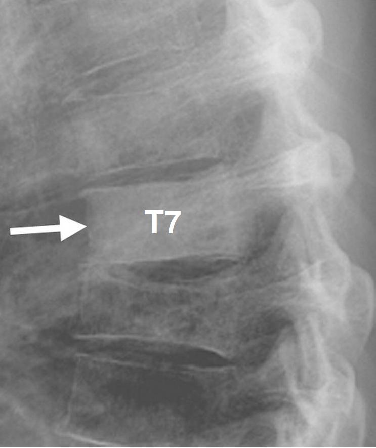 modified vertebrae