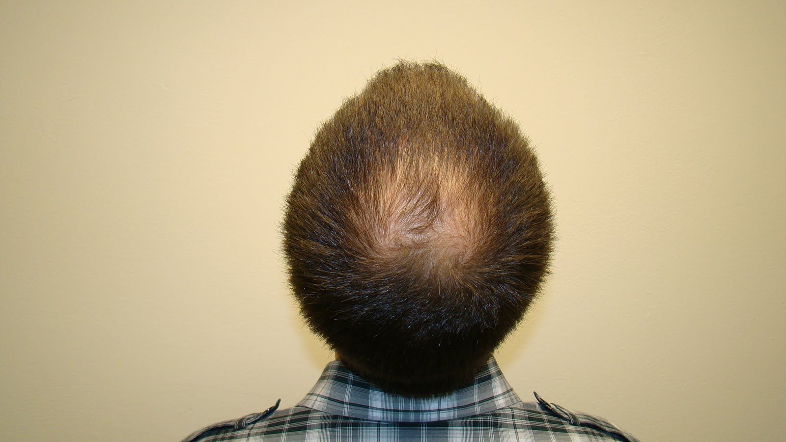 Crown Transplant