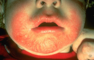 http://3.bp.blogspot.com/-YtZjeklAViE/USO-a6QXoKI/AAAAAAAABNg/RfzPoc-bwTo/s1600/red-itchy-skin-infant-1.JPG