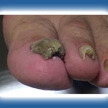 Que médico el hongo que cura de las uñas