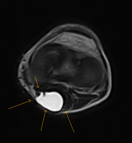 cyst mri baker pediatric bakers knee radiology neck bursa