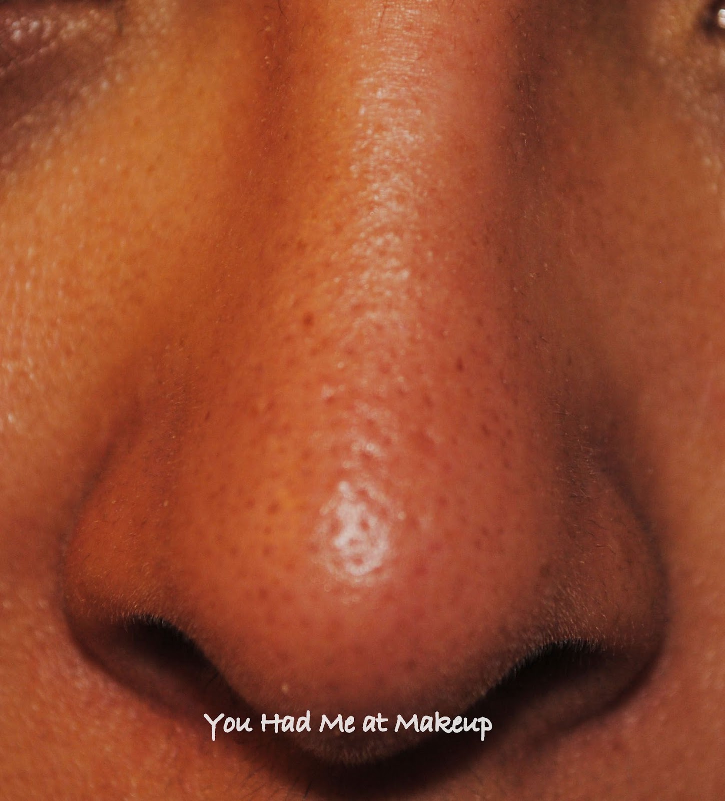 blackheads nose