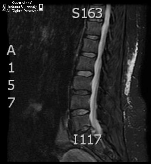 Neuroradiology On the Net Lumbar disc extrusion with a wrapped disc