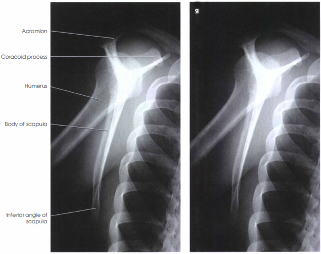 LATERAL PROJECTION RAO OR LAO SCAPULA RadTechOnDuty