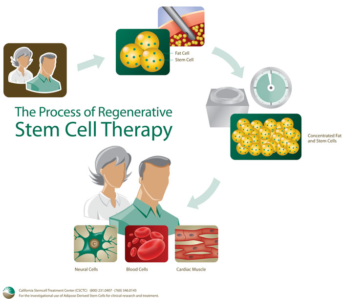 stem cell therapy cost stem cell therapy cost